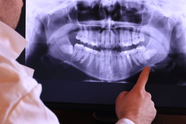 Best Emergency Root Canal Treatment in Grove City, FL