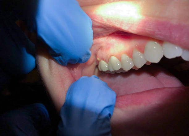Best Emergency Treatment for Dental Infections or Abscesses in Grove City, FL