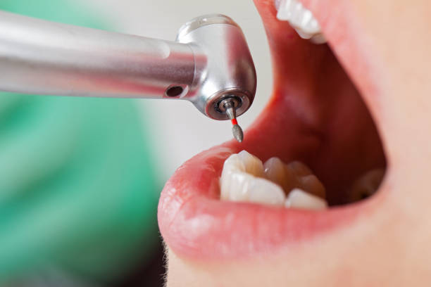 Best Emergency Dental Care for Broken or Chipped Teeth in Grove City, FL